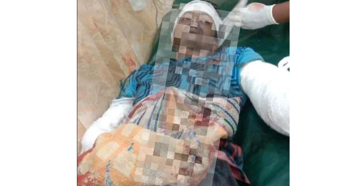 নাটোরে পারিবারিক কলহের জের-ছোট ভাইয়ের দুইহাত কেটে দিল বড়ভাই